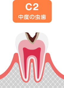 歯の内部まで進行した虫歯