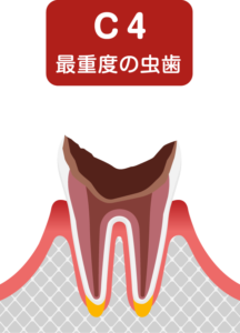 歯の根(歯質)が失われた歯