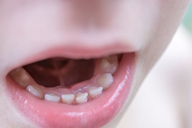 子どもの歯の特徴